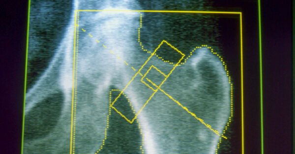 GLP-1s may increase risk of osteoporosis and gout, new research finds