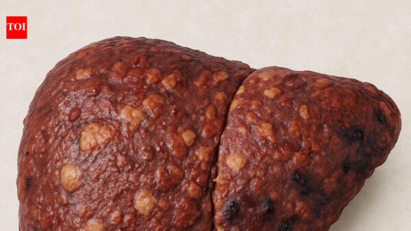 Late night binging, poor sleep, long sitting? A liver warning for young Indians | Delhi News