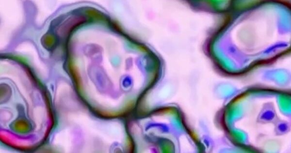 South Carolina’s measles outbreak declared over